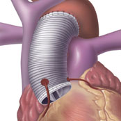 Artificial Aortic Valve Mounted on a Fabric Tube Graft
