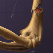 Spiral Fracture of the Humerus