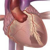 Myocardial Infarction (Heart Attack)